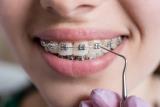 COLOCACIÓN DE BRACKETS